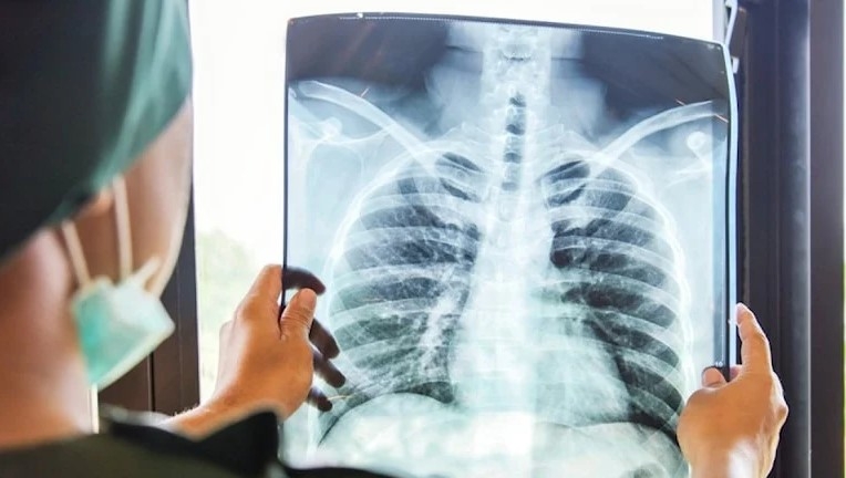 2021’de 1.6 milyon kişi verem yüzünden öldü