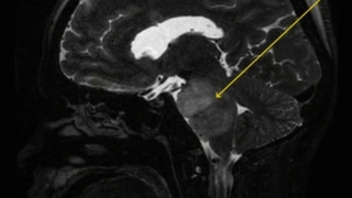 4 aydır hiç durmadan hıçkırıyor