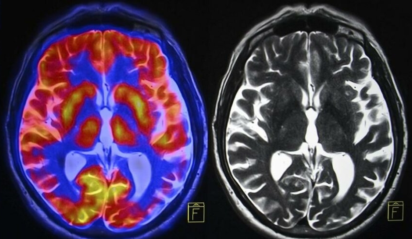 Alzheimer’la mücadelede müthiş başarı