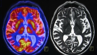 Alzheimer’la mücadelede müthiş başarı