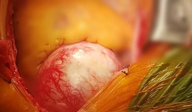 Aort damarı 3 kat büyüyen hasta ölümden döndü
