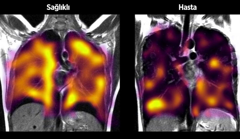 Araştırma: Koronavirüs, akciğerlerde gizli hasar bırakabilir