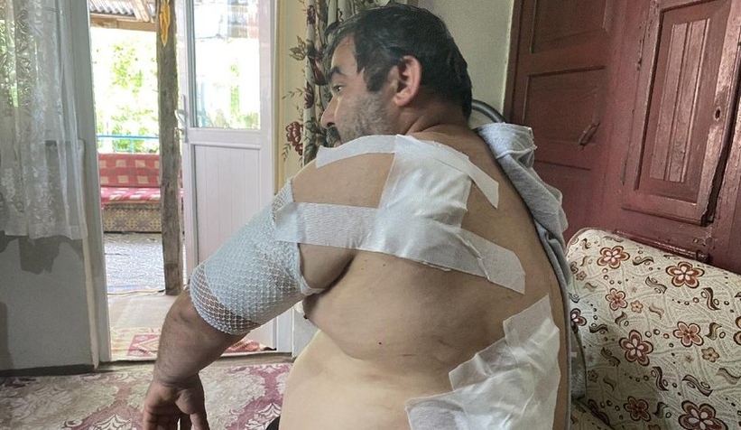 Ayı saldırısına uğrayan vatandaş: Beni öldü zannetti