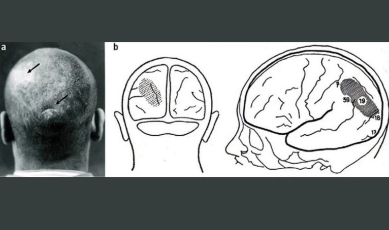 Başından vurulan hasta, dünyayı ters görmeye başladı