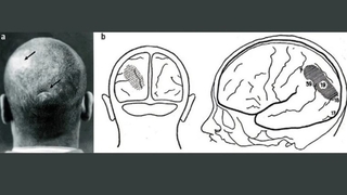 Başından vurulan hasta, dünyayı ters görmeye başladı