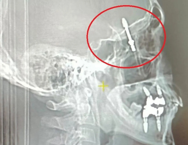 Böylesi görülmedi: İmplant tedavisinde vida beynine saplandı