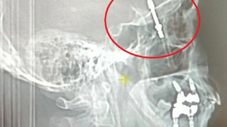 Böylesi görülmedi: İmplant tedavisinde vida beynine saplandı