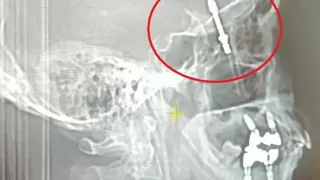 Böylesi görülmedi: İmplant tedavisinde vida beynine saplandı