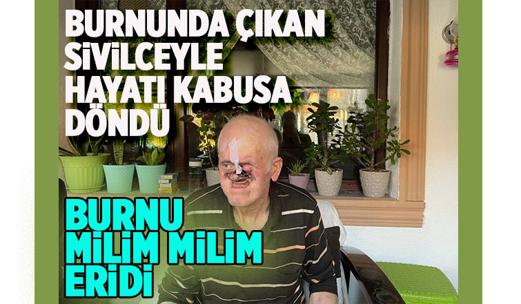 Burnunda çıkan sivilceyle hayatı kabusa döndü