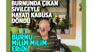 Burnunda çıkan sivilceyle hayatı kabusa döndü