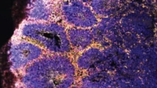 Covid-19 beyin hücrelerini öldürüyor