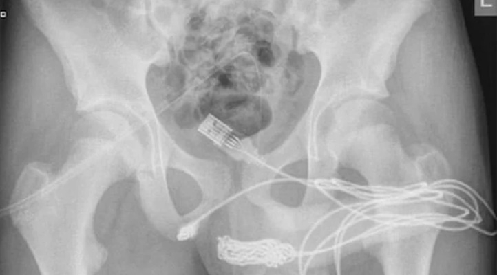 Doktorlar şaştı kaldı: Ameliyatla çıkardılar