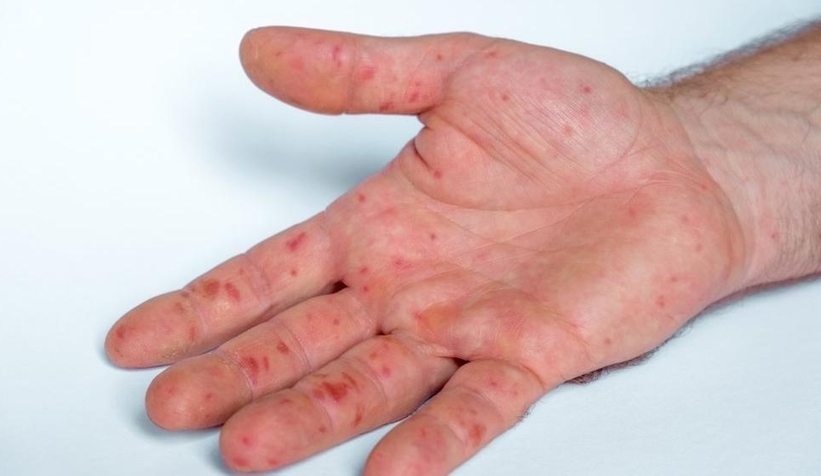 DSÖ: Maymun çiçeğinde can kaybı arttı