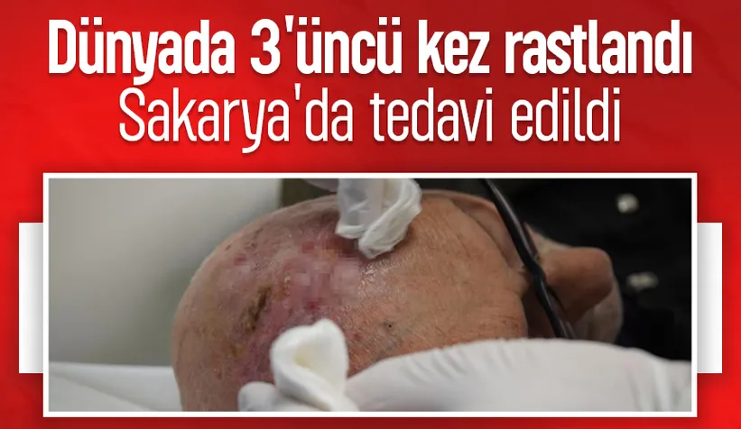 Dünyada üçüncü kez görülen nadir tümör tedavi edildi