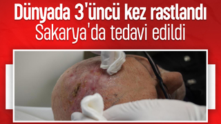 Dünyada üçüncü kez görülen nadir tümör tedavi edildi