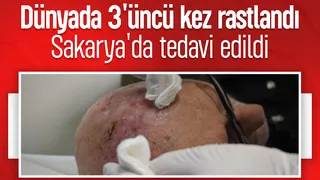 Dünyada üçüncü kez görülen nadir tümör tedavi edildi
