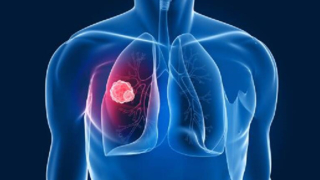 Erken evre akciğer kanseri için yeni buluş