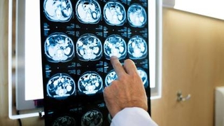 Felç tedavisinde umut veren yeni çalışma