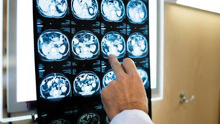 Felç tedavisinde umut veren yeni çalışma