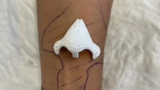 Fransa’da çığır açan tedavi: Burnu kolunda yeniden çıktı