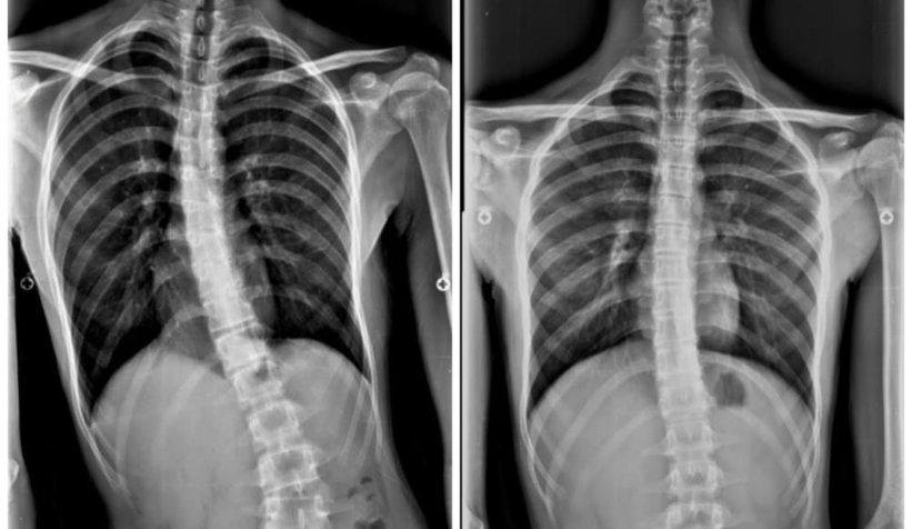 Bisiklet kazasıyla hastalığı fark edildi