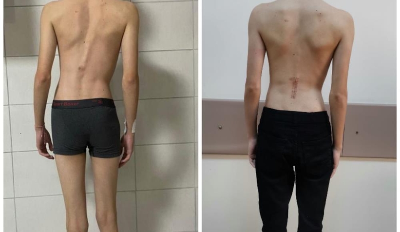 Bisiklet kazasıyla hastalığı fark edildi