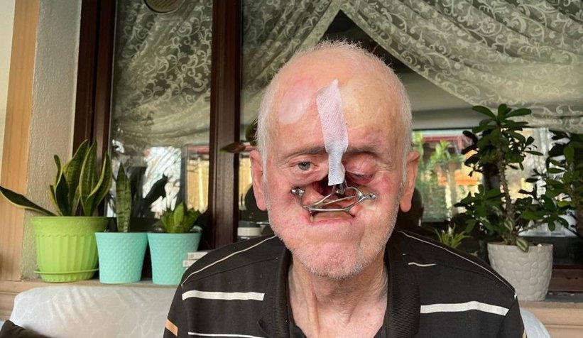 Burnunda çıkan sivilceyle hayatı kabusa döndü