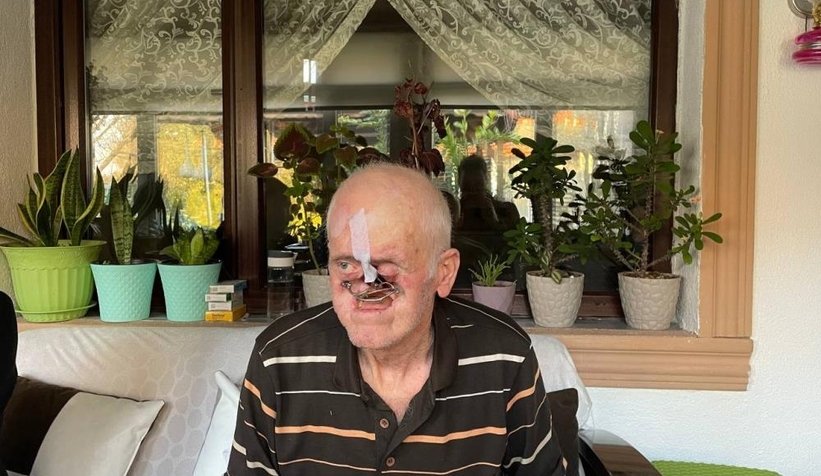 Burnunda çıkan sivilceyle hayatı kabusa döndü