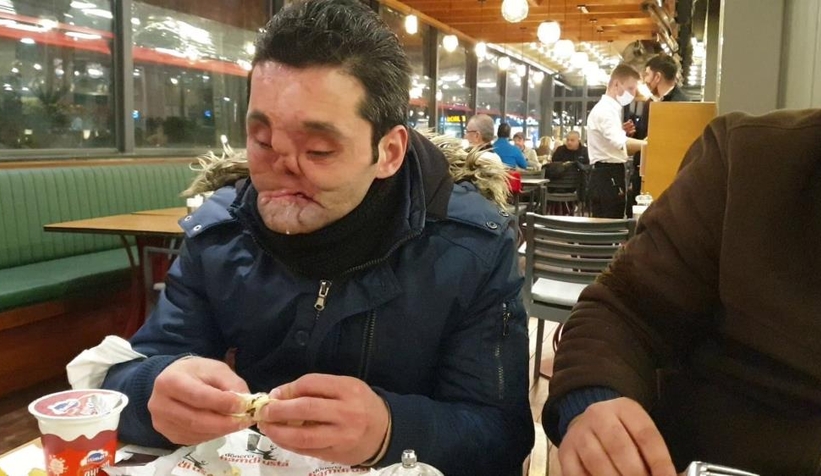 Gözlerini, çenesini ve burnunu kaybeden gencin hayali gerçek olacak