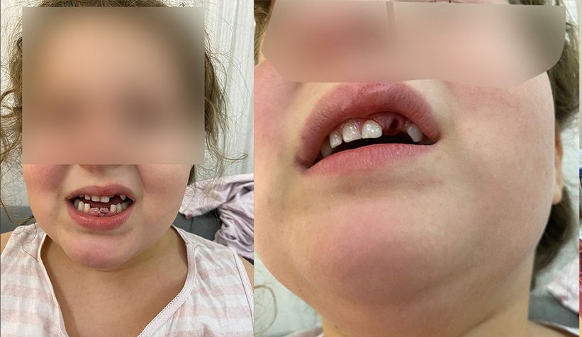 Kız çocuğu bozuk yolda düştü, dişleri kırıldı