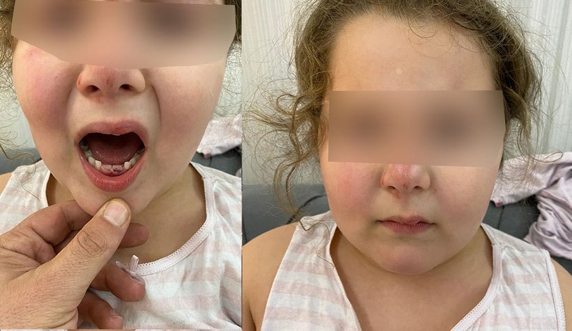 Kız çocuğu bozuk yolda düştü, dişleri kırıldı