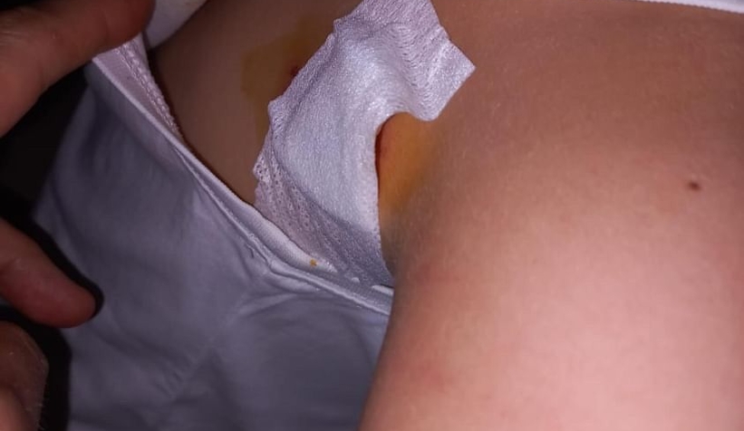 Kurt köpeğinin saldırdığı çocuk yaralandı