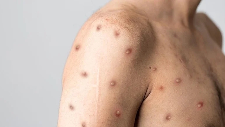 Maymun çiçeğinde semptomlar değişiyor