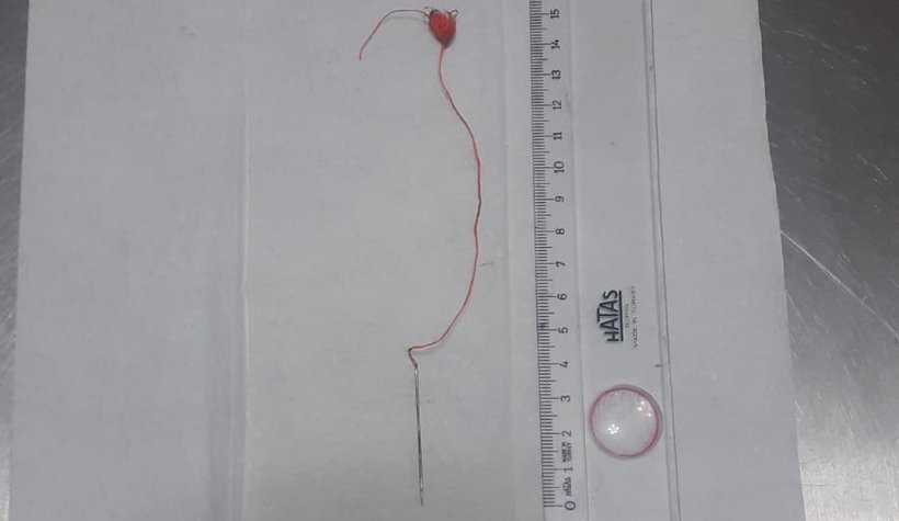 Sasha'nın midesinden iğne çıkarıldı