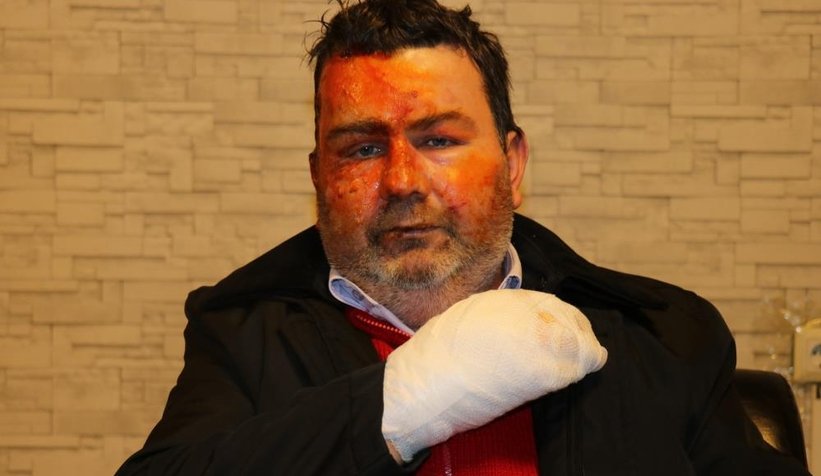 Uyurken yüzünü yaktı