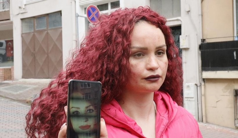 Yüzündeki lekeleri sildirmek için gitti, şok yaşadı