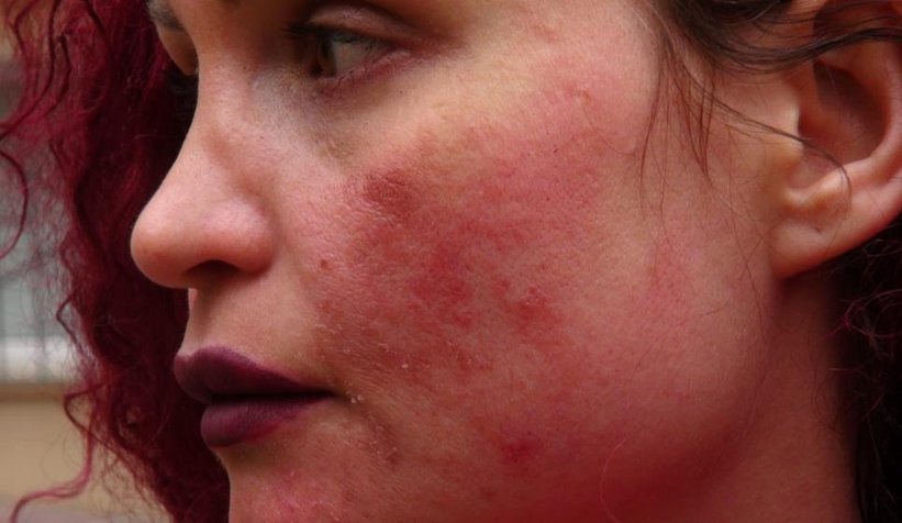 Yüzündeki lekeleri sildirmek için gitti, şok yaşadı