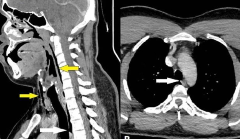 Hapşırığını tutunca nefes borusu yırtıldı
