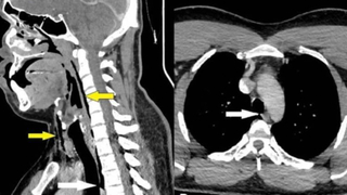 Hapşırığını tutunca nefes borusu yırtıldı