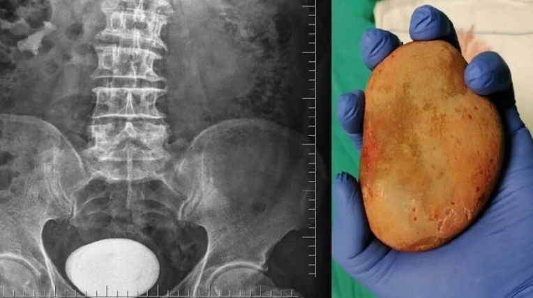 Hastanın mesanesinden çıktı! Doktorlar bile şaşırdı