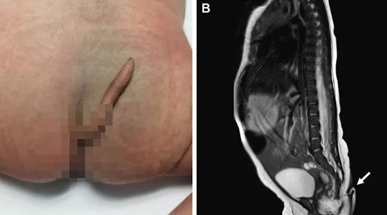 İnanılmaz olay: 6 cm kuyrukla dünyaya geldi