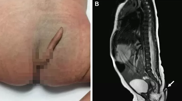 İnanılmaz olay: 6 cm kuyrukla dünyaya geldi