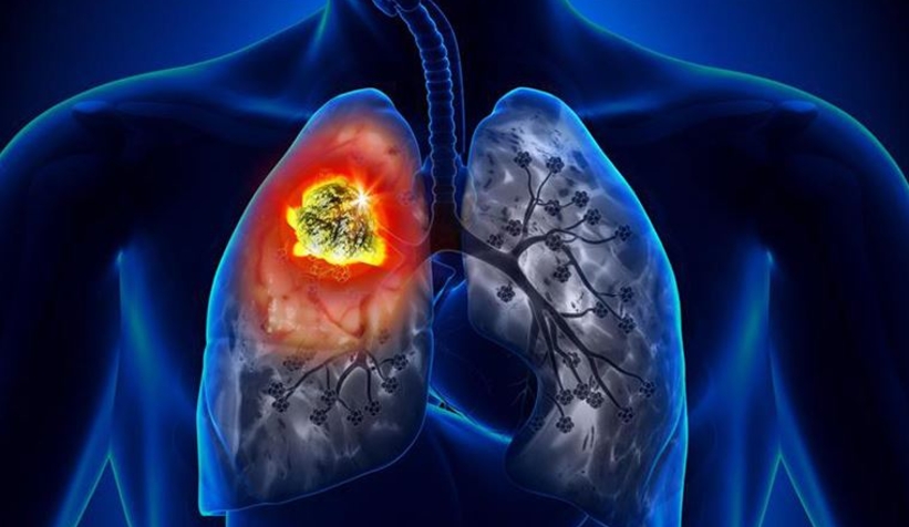 Korona akciğer kanserinin tanısını geciktiriyor