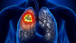 Korona akciğer kanserinin tanısını geciktiriyor