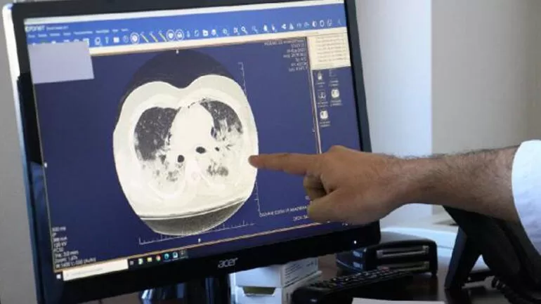 Korona ciğerleri bu hale getiriyor