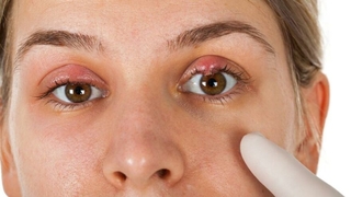 Korona gözlerde nodül oluşuyor