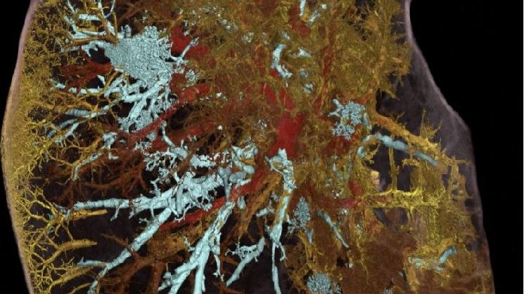 Koronanın akciğerdeki korkunç tahribatı ilk kez görüntülendi