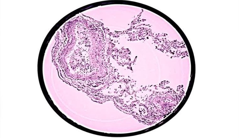 Koronavirüsün akciğerdeki yayılışı 3 boyutlu modellendi
