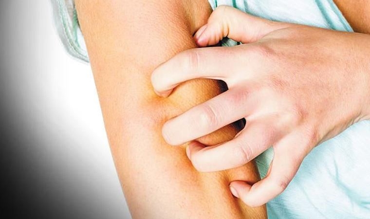 Kurdeşen hayatınızı kabusa çevirebilir 