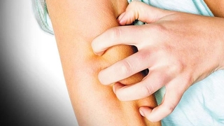 Kurdeşen hayatınızı kabusa çevirebilir 